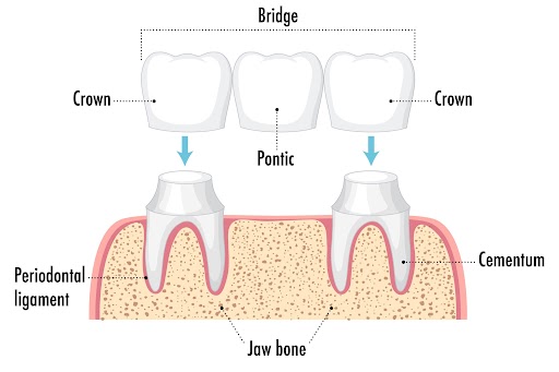 Infographic of human in dental bridge on white background