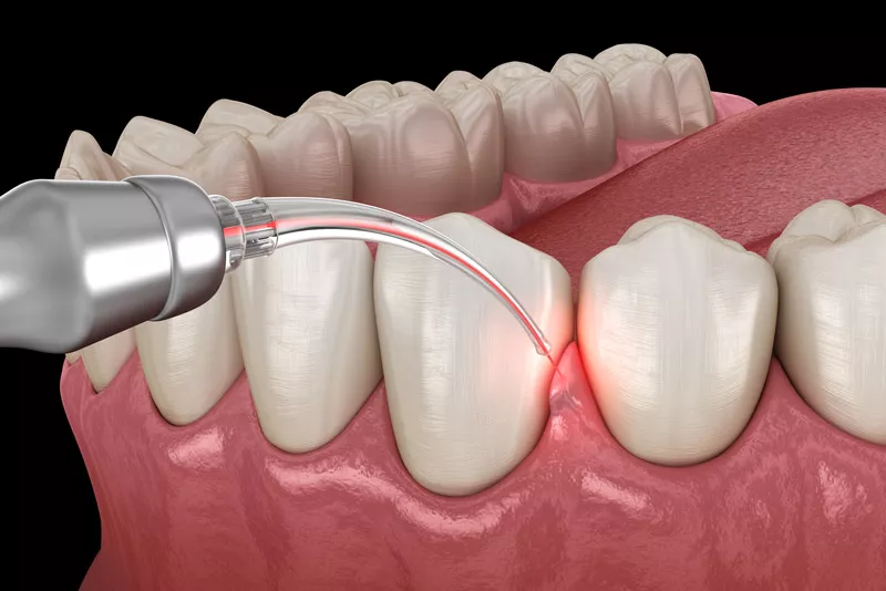 Gum-Treatment