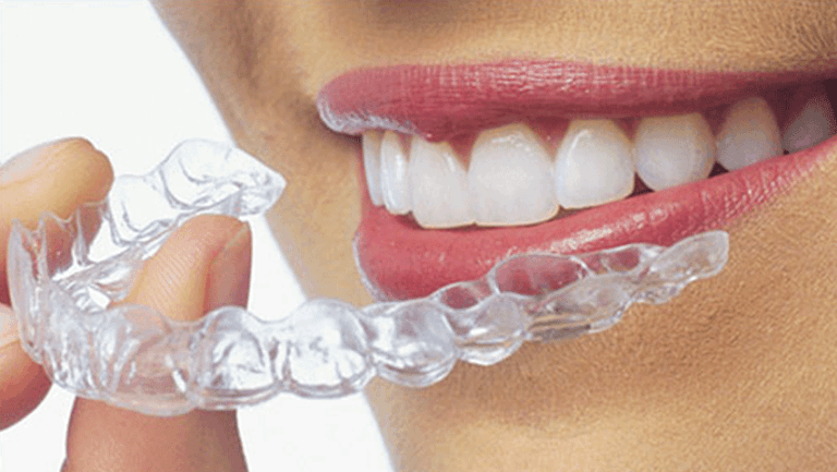 Aligners-768x433