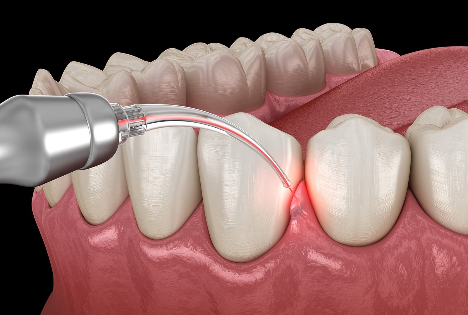 Gum Treatments