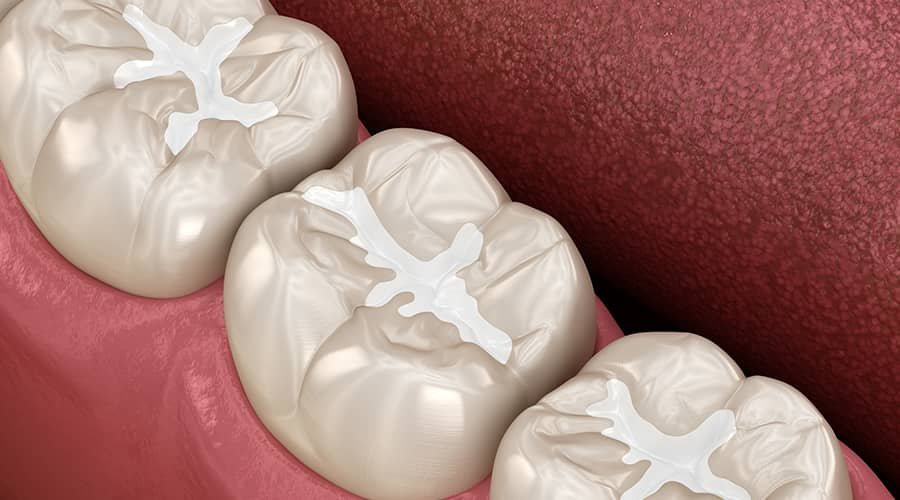 Dental Fillings and Restorations