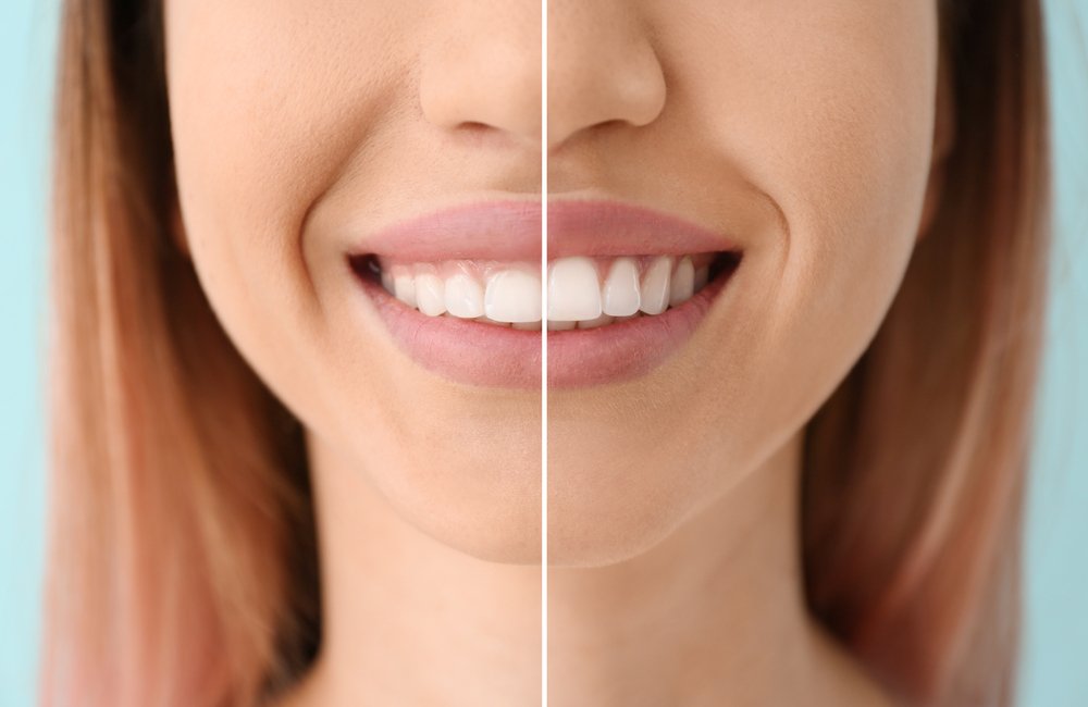 Smile Correction